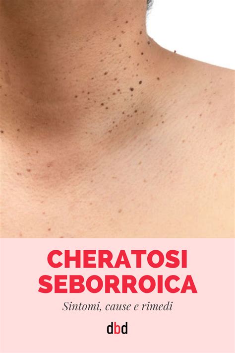 cheratosi seborroica malattia.